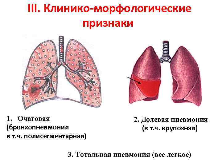 Чем отличается пневмония от воспаления легких: в чем разница или это одно и тоже?