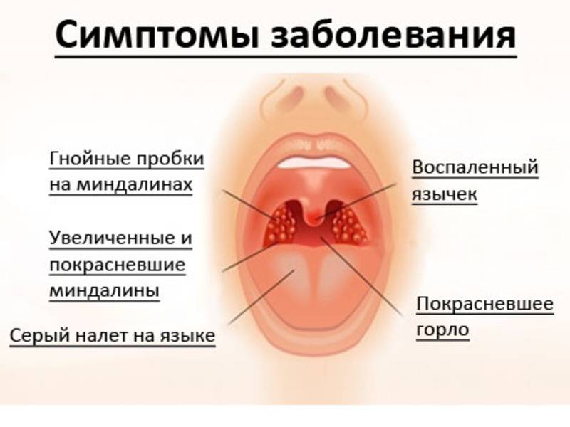 Чем полоскать горло при хроническом тонзиллите pulmono.ru
чем полоскать горло при хроническом тонзиллите