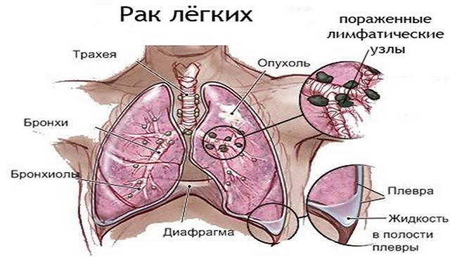 Пневмония при раке легких: может ли быть, симптомы и лечение