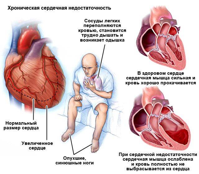 Застойная пневмония лечение при сердечной недостаточности