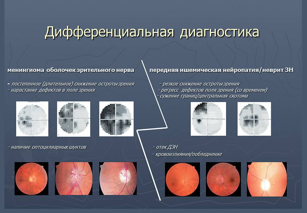 Причины и лечение атрофии зрительного нерва различной степени тяжести, симптомы и прогноз для пациента