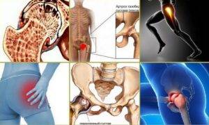 Артроз тазобедренного сустава: симптомы, методы лечения, стадии