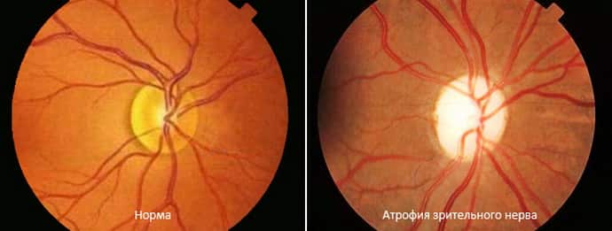 Частичная атрофия зрительного нерва – грозное, но корректируемое заболевание