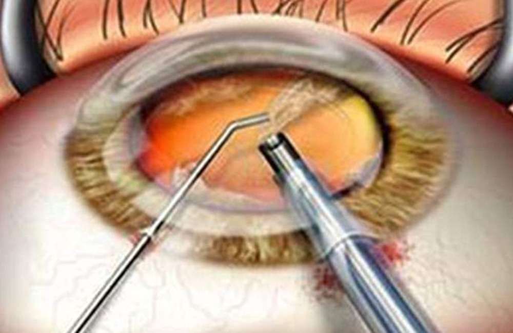 Лечение катаракты народными средствами - эффективные рецепты