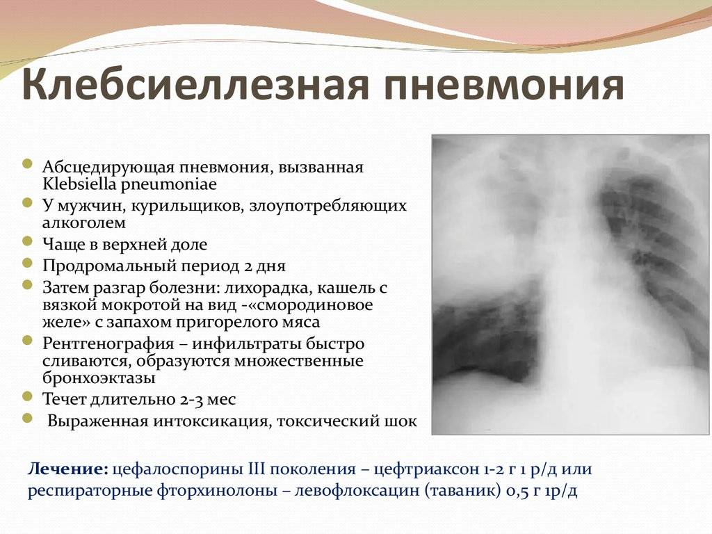 Симптомы воспаления легких у взрослых: пневмонии