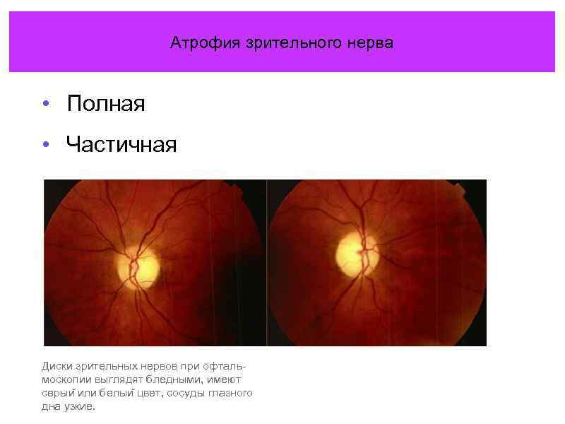 Атрофия зрительного нерва: причины, симптомы, лечение