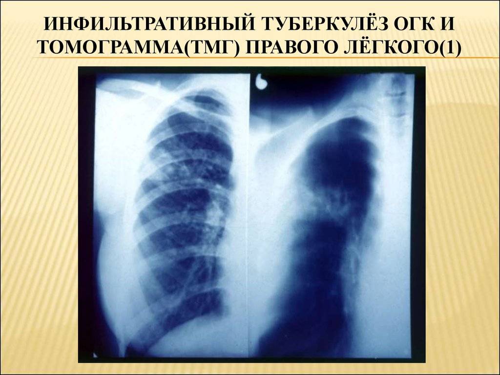 Инфильтративный туберкулез левого и правого легкого: лечение и дифференциальная диагностика