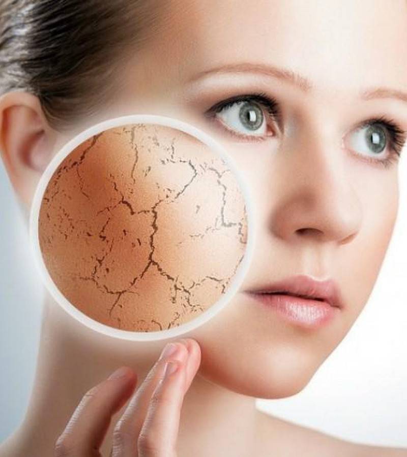 Сухая кожа лица: причина сухости кожи, лечение ксероза, выбор крема и масок при сухой коже