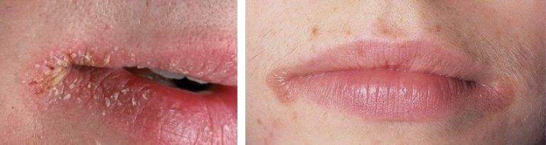 Корки в носу: кровяные, сухие - почему образуются, как лечить детям и взрослым