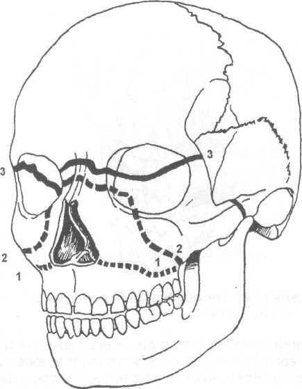 Переломы верхней челюсти: этиология, клиника, диагностика и лечение — интернет-сообщество нейрохирургов росcии