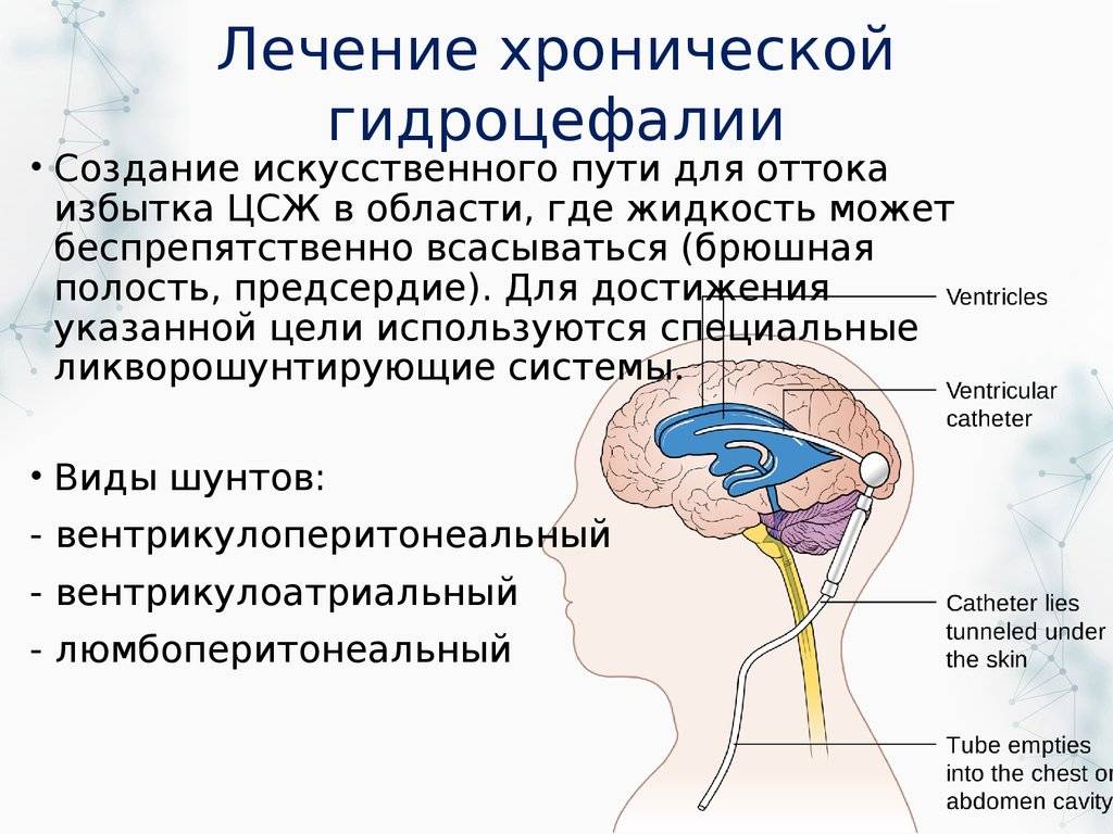Смешанная гидроцефалия головного мозга у взрослых: симптомы и лечение