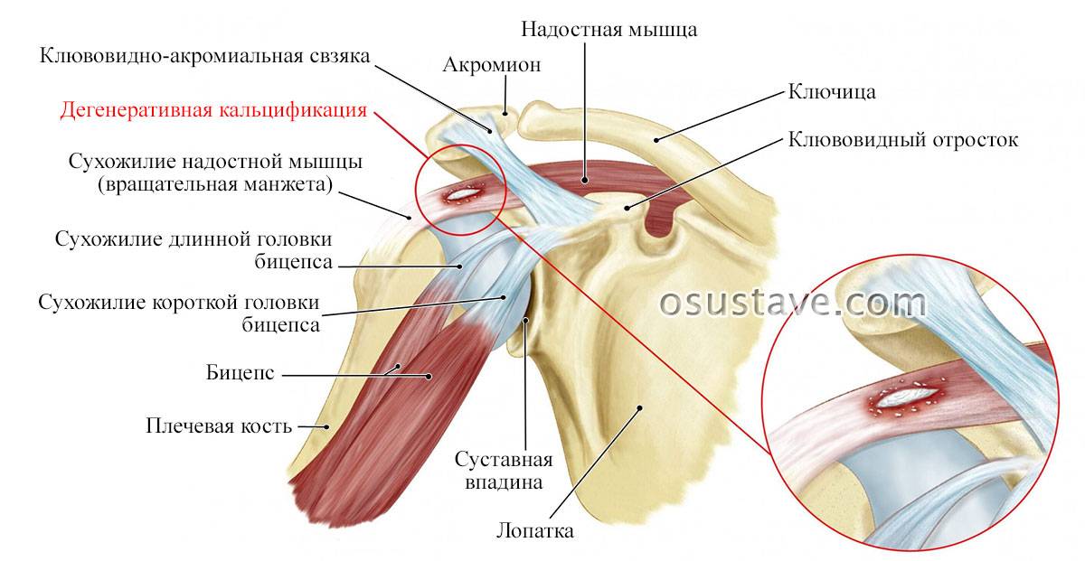 Тендиноз сухожилия надостной мышцы плечевого сустава - мирсуставов