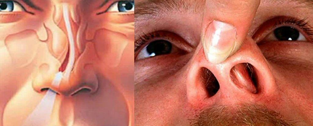 Отек в носу без насморка - отекает слизистая и не проходит несколько месяцев у ребенка, причины у взрослых, лечение