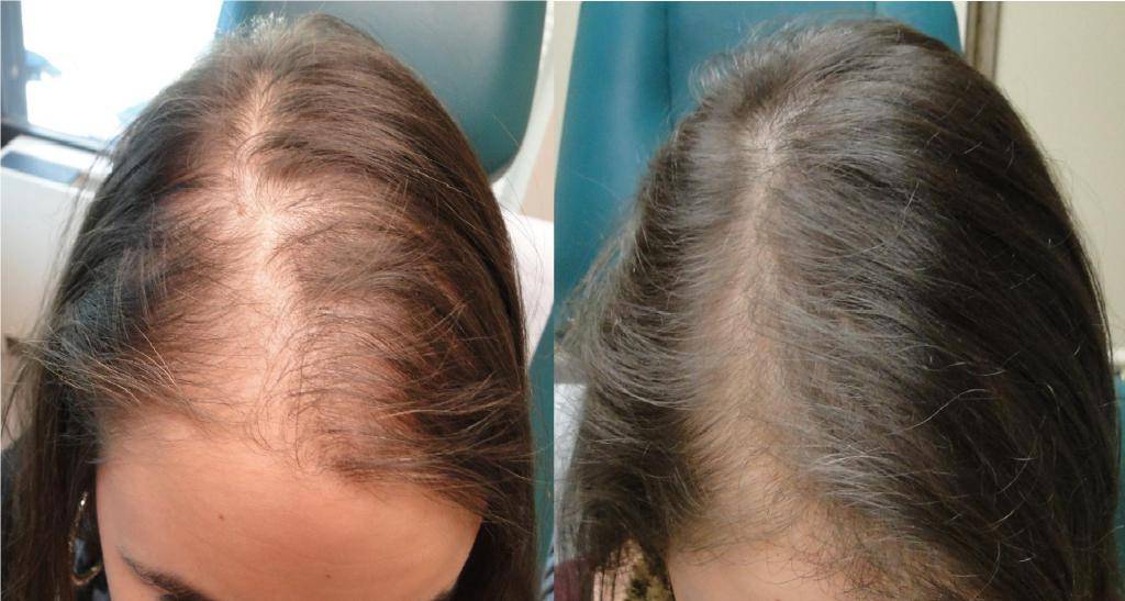 Можно ли вылечить андрогенную алопецию? причины облысения. трансплантация волос