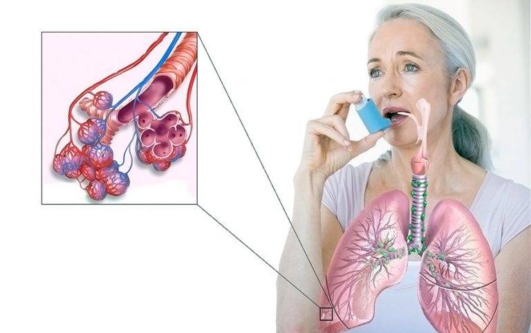 Кашель при астме: виды, симптомы и лечение