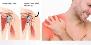 Как лечить капсулит плечевого сустава