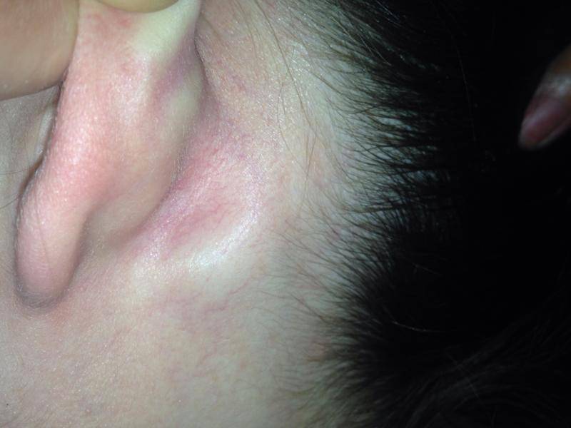 Воспаление лимфоузлов возле уха: причины, симптомы, диагноз, лечение и профилактика