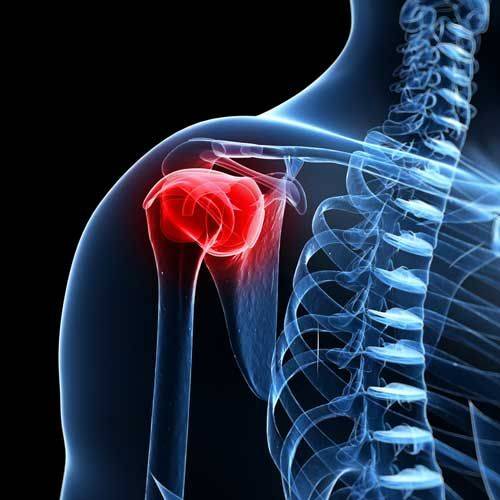 Лечение артрита плечевого сустава: лекарственные препараты и народные средства