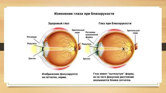 Миопия слабой степени (1 стадии): что это такое, лечение обоих глаз