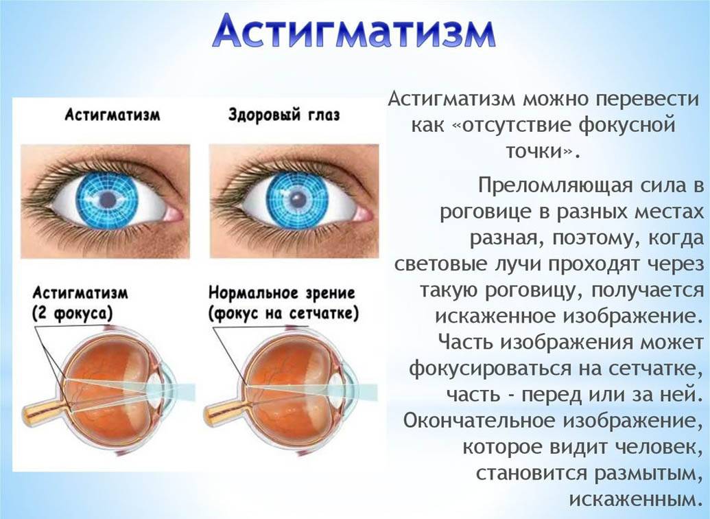 Лечение амблиопии. восстановление бинокулярного зрения | мнтк «микрохирургия глаза» им. акад. с.н. федорова