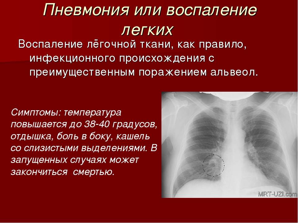 Пневмония без температуры у ребенка: признаки, симптомы и лечение