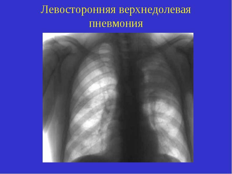 Левосторонняя нижнедолевая пневмония: диагностика и лечение