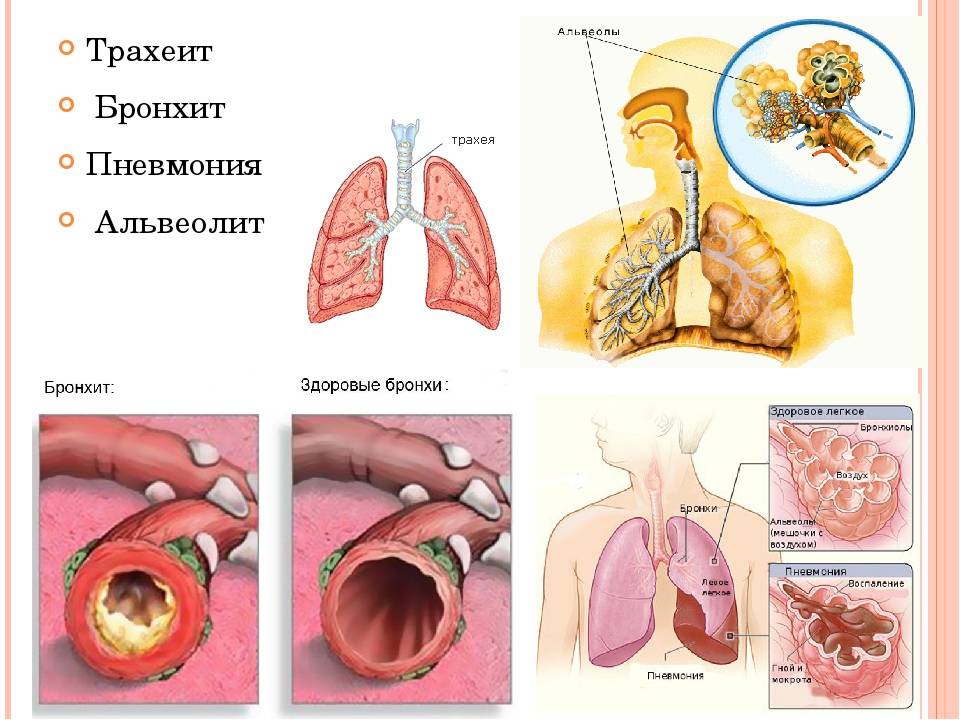 Как бронхит отличить от пневмонии: клиническая картина