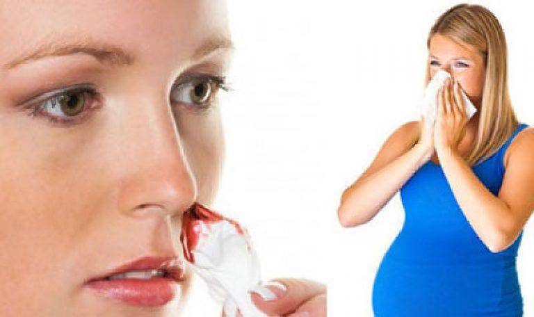Кровь из носа при беременности: что делать, если идет во время третьего, второго или первого триместра, кровь запекается - корочки