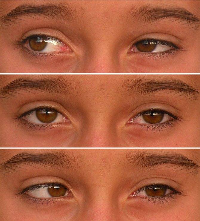 Поддается ли лечению амблиопия у взрослых | про болезни глаз