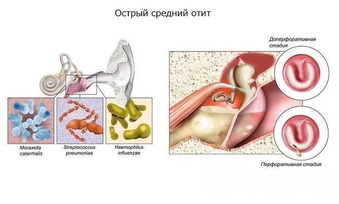 Отит - симптомы у взрослых, признаки и лечение острого у взрослых, воспаление среднего уха, болезнь с температурой, как определить