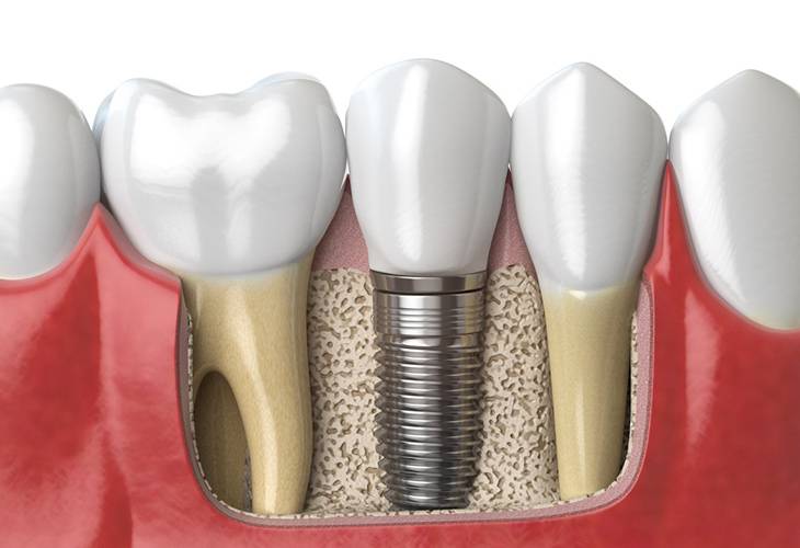Имплантация верхней челюсти: особенности методики, осложнения, цена, мнение стоматологов