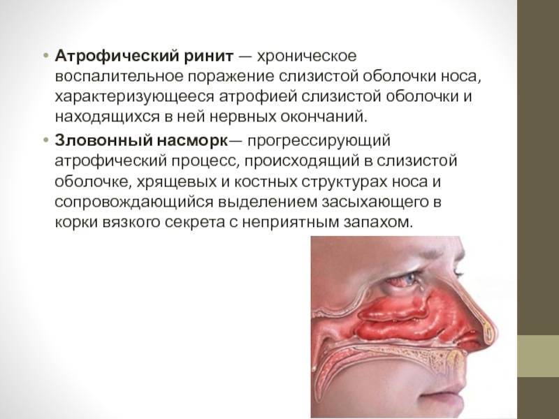 Хроническое заболевание полости носа, характеризующееся атрофией слизистой оболочки и костного