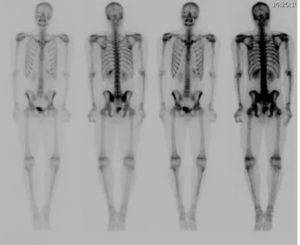 Сцинтиграфия костей скелета — что это такое и как ее проводят?