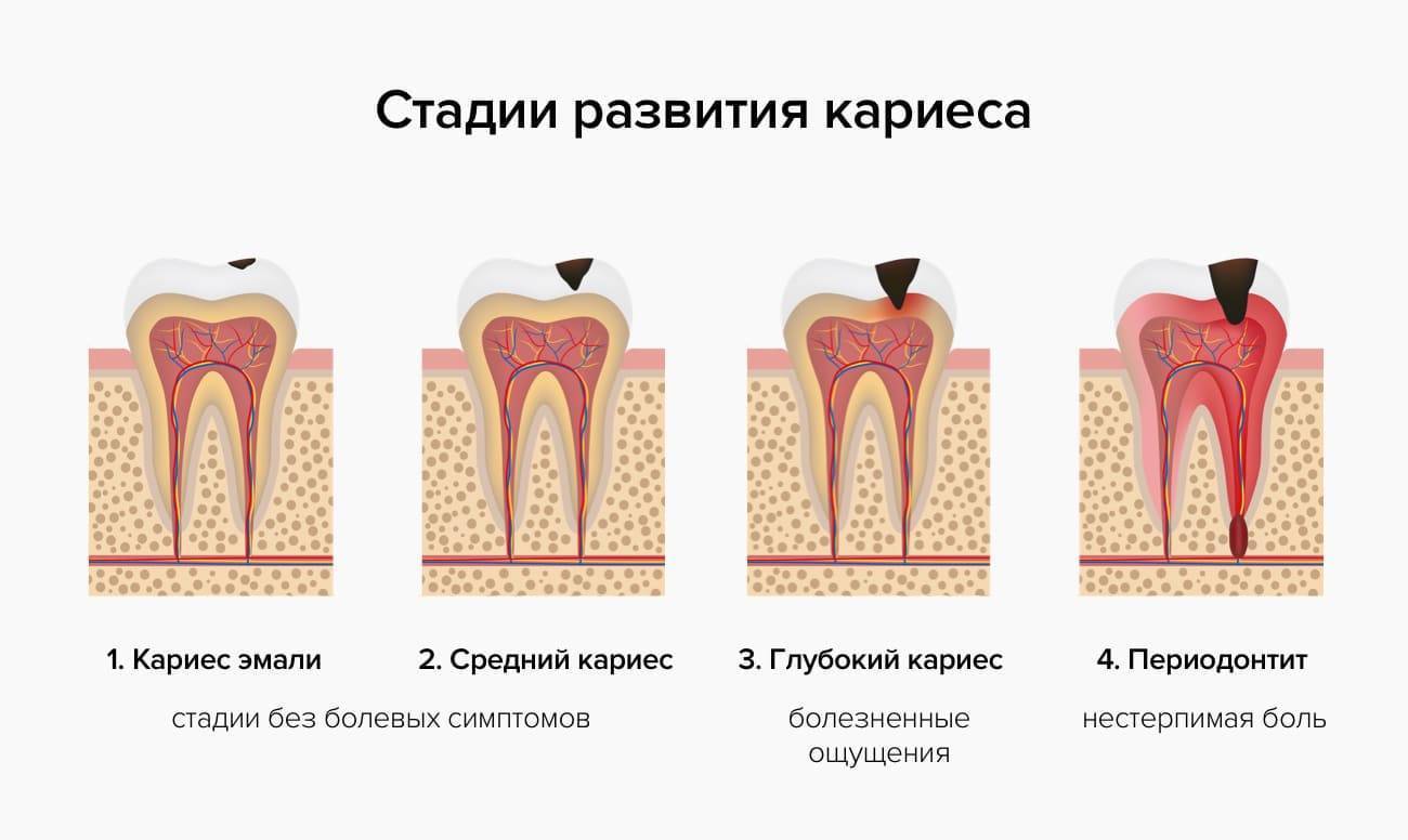 Причины появления пришеечного кариеса, способы лечения заболевания, фото пораженных зубов