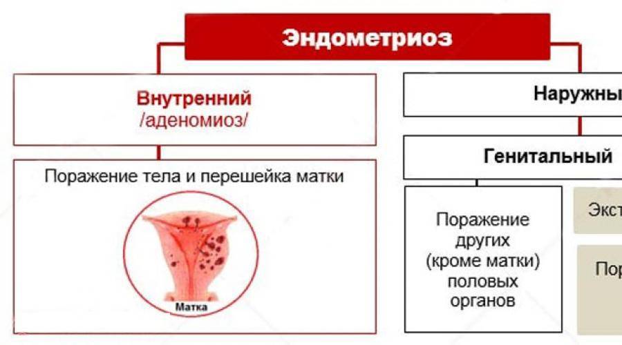 ᐉ эндометриоз матки при климаксе симптомы и лечение прогноз - sp-medic.ru