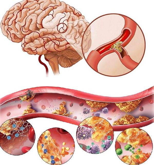 Особенности атеросклероза у пожилых людей: симптомы и лечение сосудов головного мозга и внутренних органов