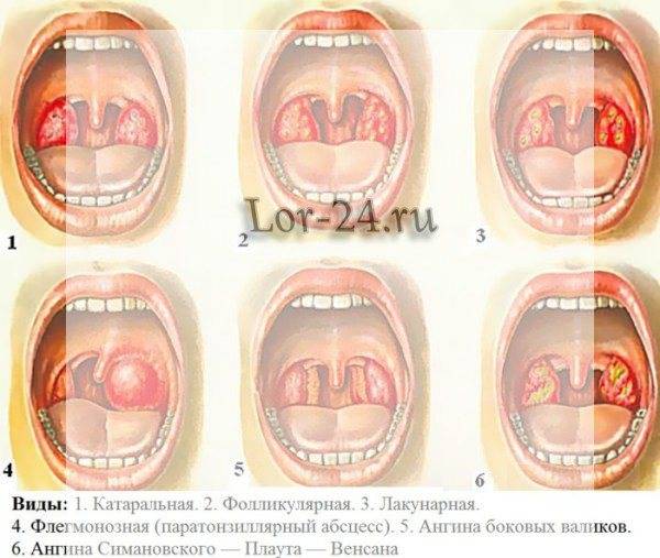Ангина симановского плаута венсана лечение