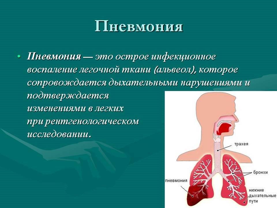 Бактериальная пневмония: что это такое, заразна или нет, как передается, симптомы и лечение