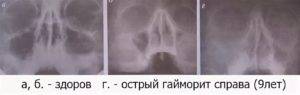 Тотальное и субтотальное затемнение гайморовых пазух pulmono.ru
тотальное и субтотальное затемнение гайморовых пазух