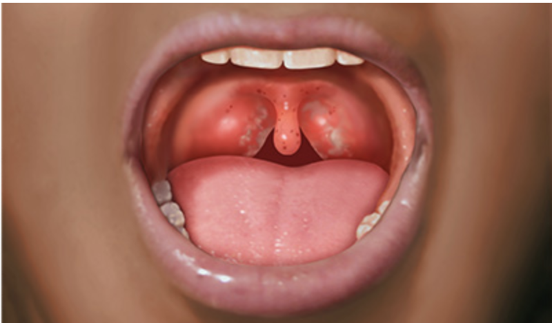 Стрептококковая инфекция у детей (40 фото): симптомы в горле, носу и на коже, лечение ангины и пневмонии у новорожденных