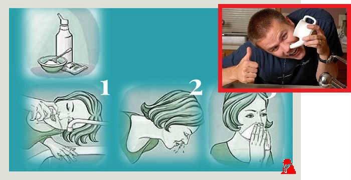 Промывание носа при гайморите | компетентно о здоровье на ilive