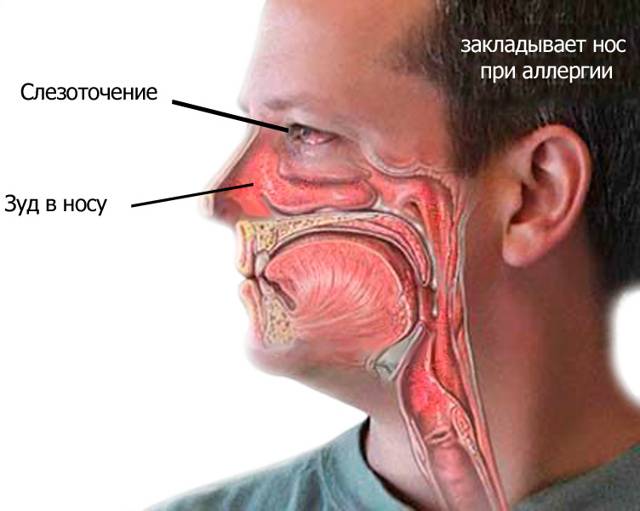 Заложенность носа без насморка у взрослых – причины и лечение