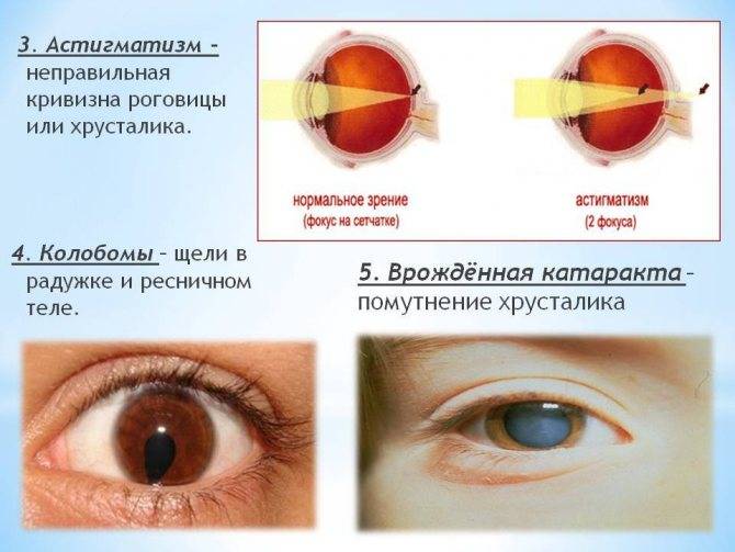 Сложный астигматизм обоих глаз: что это такое,симптомы и лечение