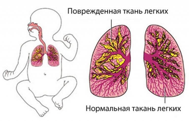 Пневмония у грудничков. симптомы воспаления легких у грудных детей