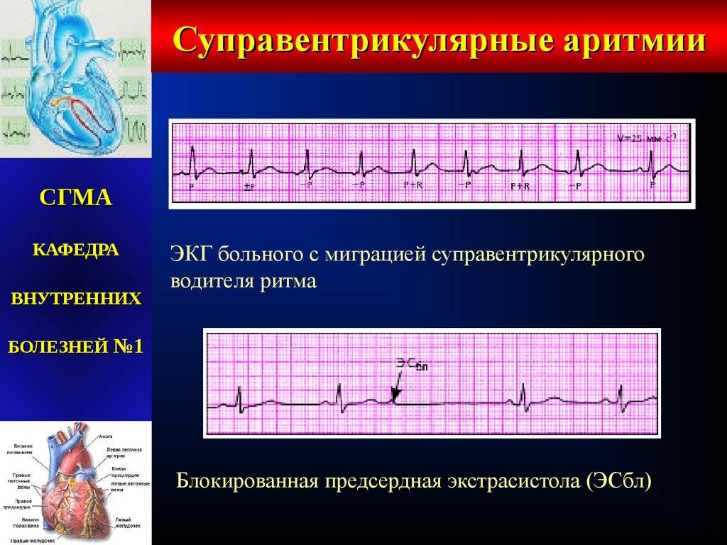 Экстрасистолия сердца: опасно ли это, ответы кардиолога, что это такое, виды и лечение