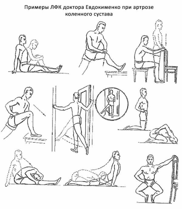 Гимнастика при артрозе коленного сустава по бубновскому, лучшие упражнения