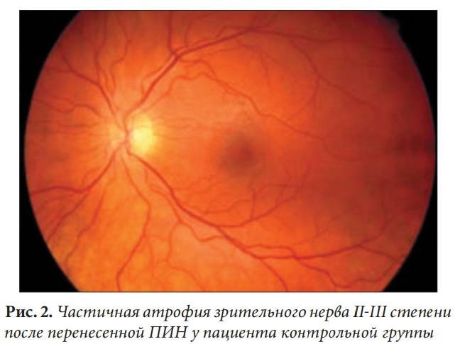 Частичная атрофия зрительного нерва: причины, диагностика, лечение и профилактика