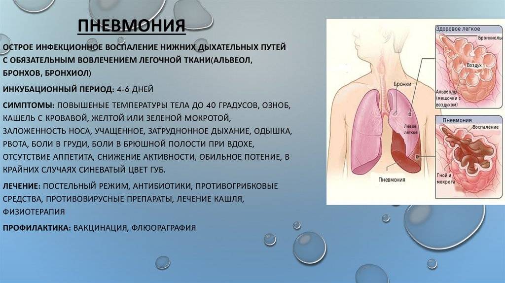 Как лечить кашель при пневмонии у взрослых