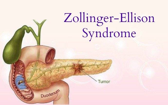 Синдром золлингера-эллисона: симптомы и лечение