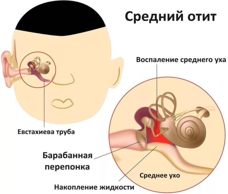 Отит среднего уха :симптомы и лечение в домашних условиях у взрослых